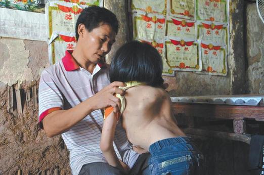 有嚴(yán)重脊椎畸形及胸腔隆突病的李文霞。