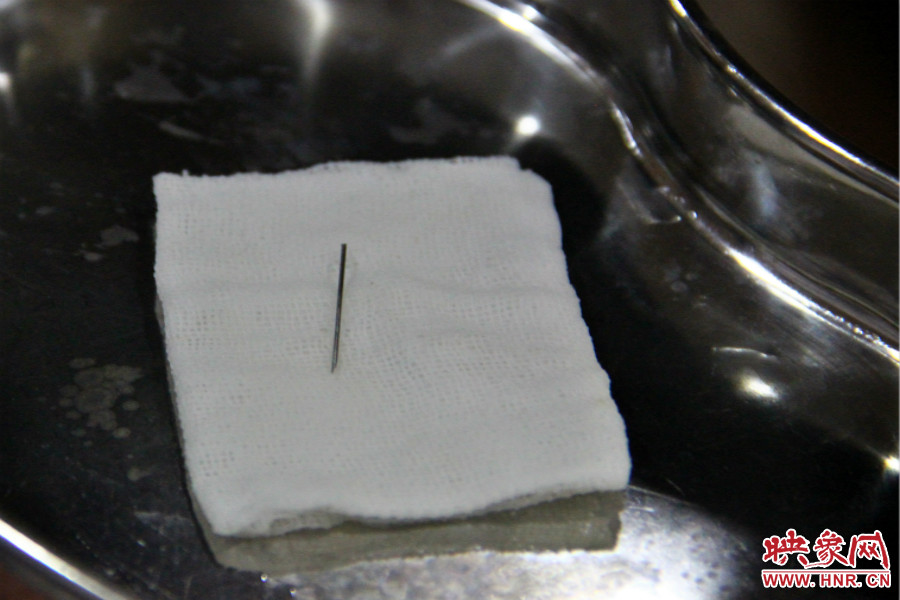 上午11點(diǎn)30分許，小龍腦中鋼針已經(jīng)成功取出。