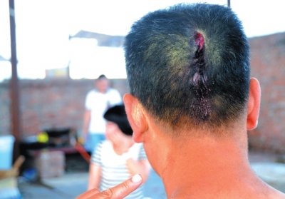 崔先生頭部受傷。京華時報記者趙思衡攝/視頻