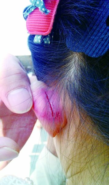　　女童的耳朵被老師揪裂。圖片由女童家人提供