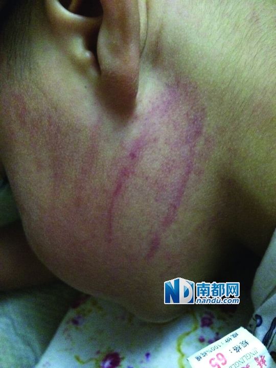 小逸臉上淤痕清晰可見。