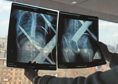 12歲女孩從6樓陽臺墜下 身體被樓下鐵柵欄刺穿 12歲女孩從6樓陽臺墜下 身體被樓下鐵柵欄刺穿