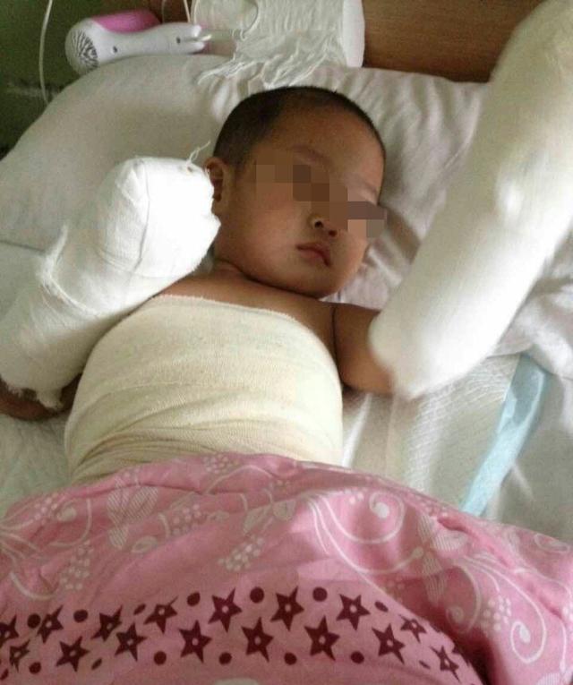 2歲娃洗澡跌入開(kāi)水鍋 雙手嚴(yán)重燙傷