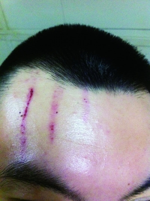 　2013年，被打者受傷照