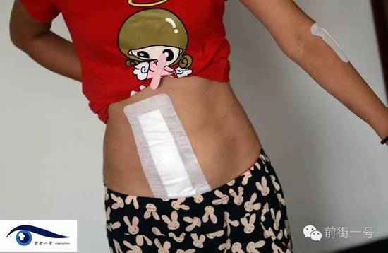 小金腹部的傷口。