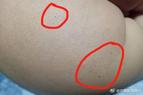 據(jù)多名紅黃藍(lán)(新天地分園)家長(zhǎng)反映，孩子腿部、屁股、腋下出現(xiàn)針眼。