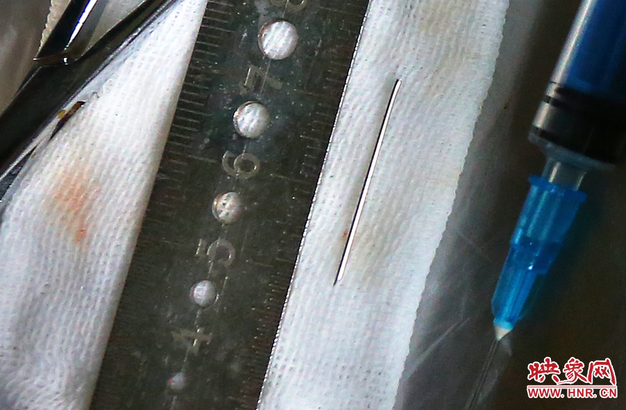 上午11點42分，大龍顱內(nèi)的鋼針被取出