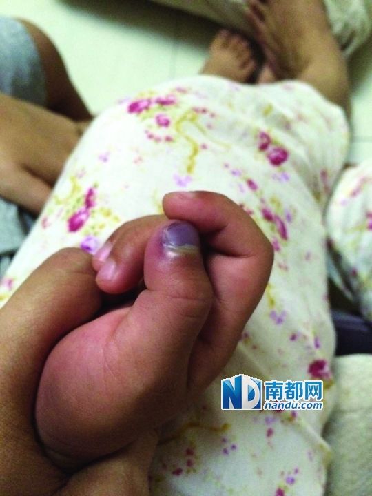 小逸手指被夾傷。