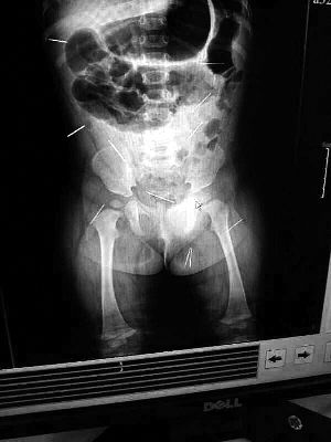 目前體內的12根鋼針多分布在孩子的臀部，一根在腹部，其余3根在胸腔附近，其中一根很接近心臟