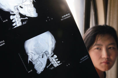 國內(nèi)醫(yī)院CT顯示，如今靳魏坤的鼻子假體是歪的，連下巴也是歪的