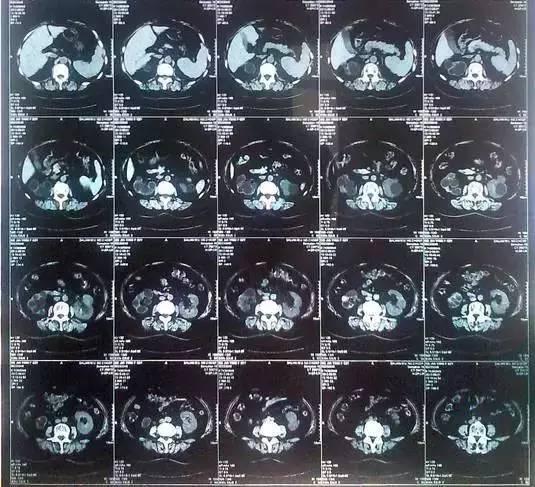 55歲大爺因愛吃豆腐 體內(nèi)取出420顆結石