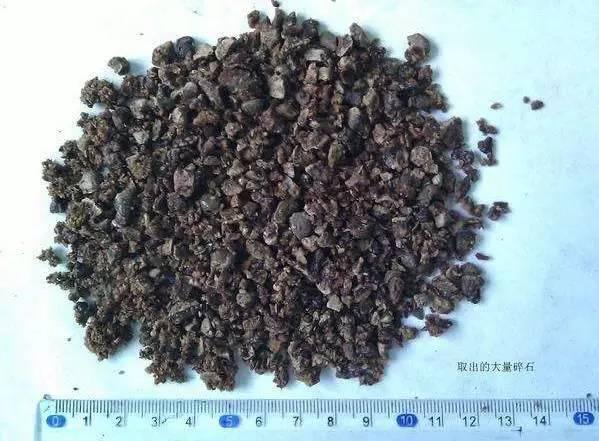 55歲大爺因愛吃豆腐 體內(nèi)取出420顆結石