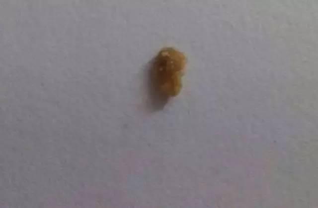 55歲大爺因愛吃豆腐 體內(nèi)取出420顆結石