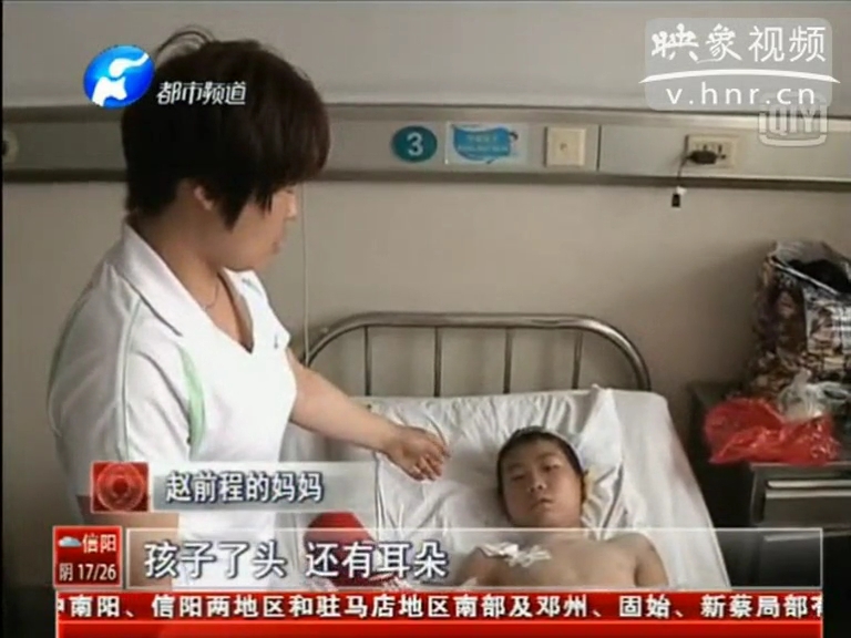 又見(jiàn)瘋狗咬傷兒童