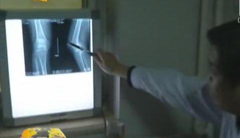 冷空氣來襲 如何預(yù)防老寒腿？