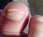 一幼兒園兒童“指甲異?！? title=